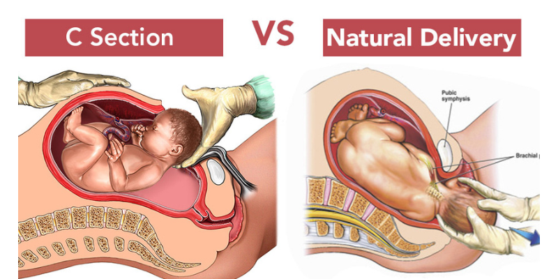 تفاوت زایمان طبیعی و سزارین چیست